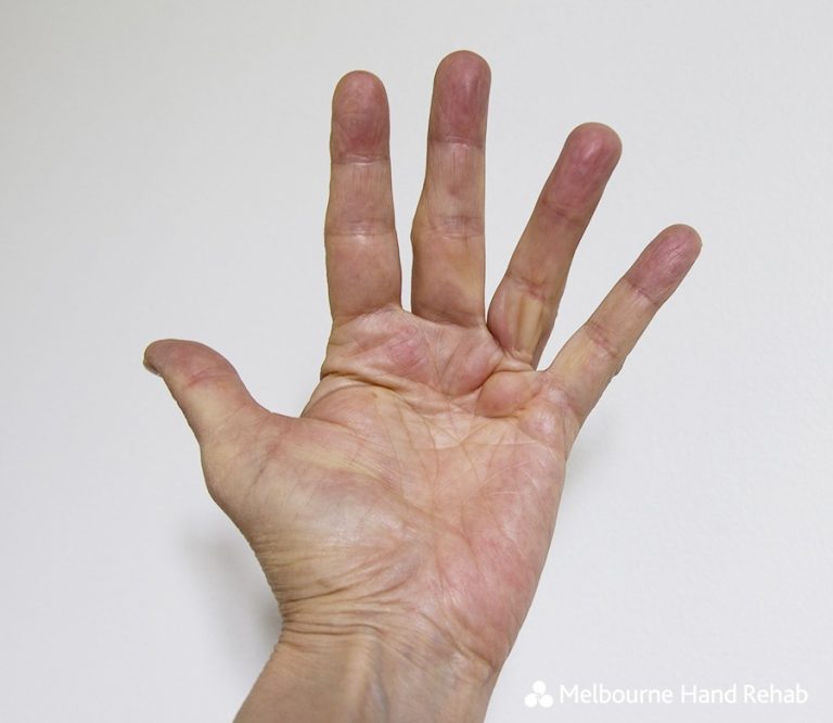 What Triggers Dupuytren S Contracture ABTC