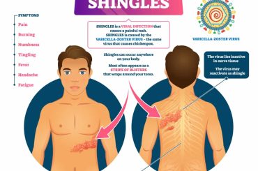 Shingles Causes Symptoms Treatment And Prevention Abtc