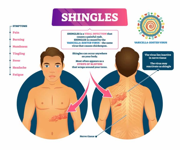 Shingles Causes Symptoms Treatment And Prevention ABTC