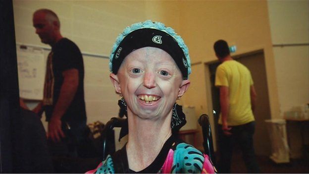 Is Hayley with progeria still alive? Who is the oldest person with ...