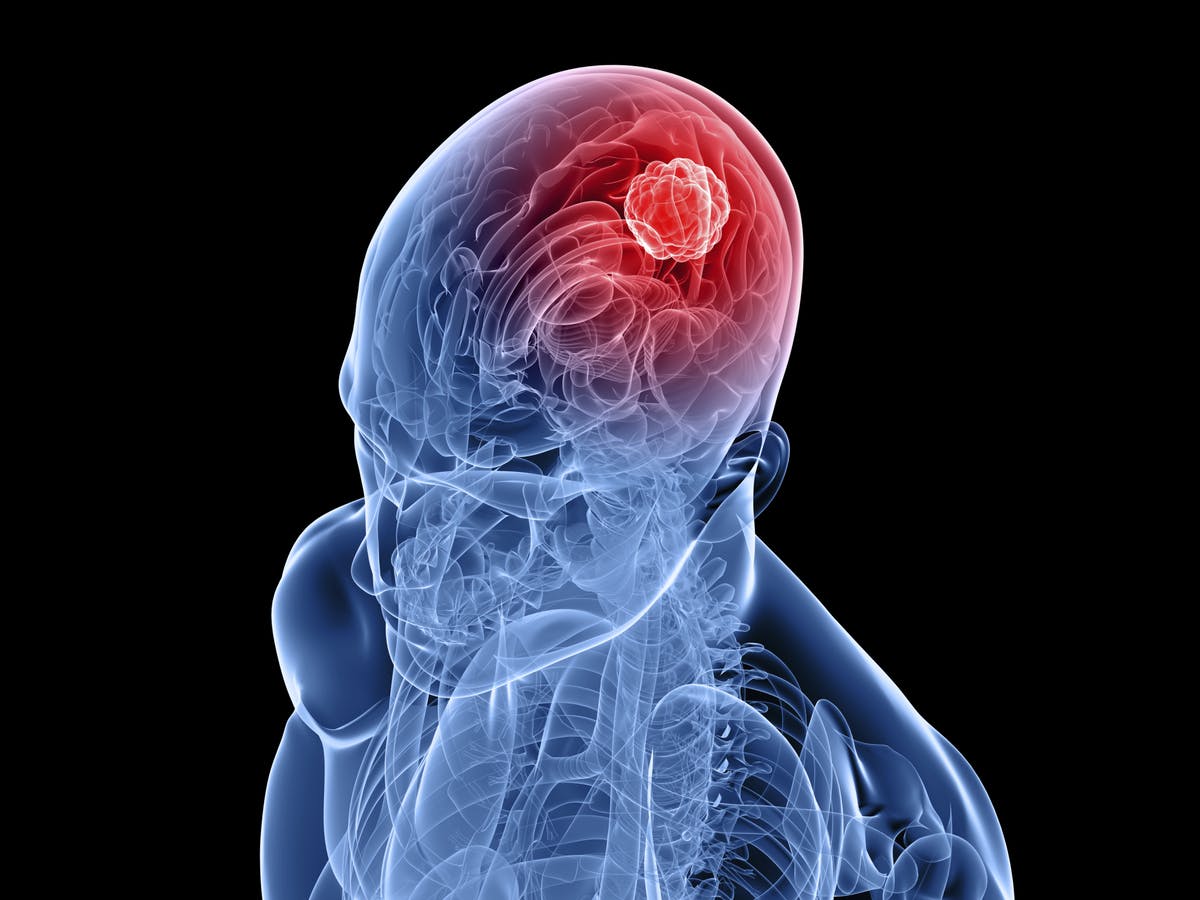 Glioblastoma Causes, Symptoms, Treatment and Prognosis ABTC