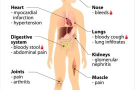 Vasculitis Causes Symptoms Types And Treatment Abtc