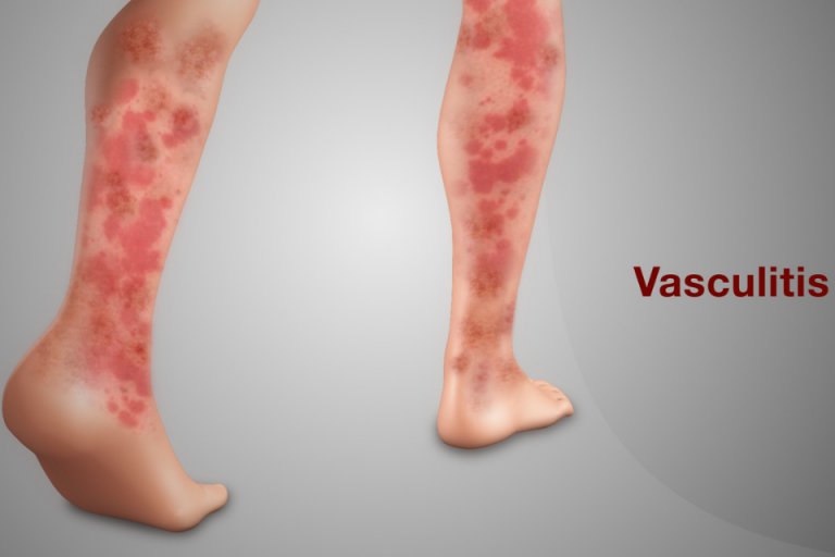 Vasculitis Causes Symptoms Types And Treatment Abtc 