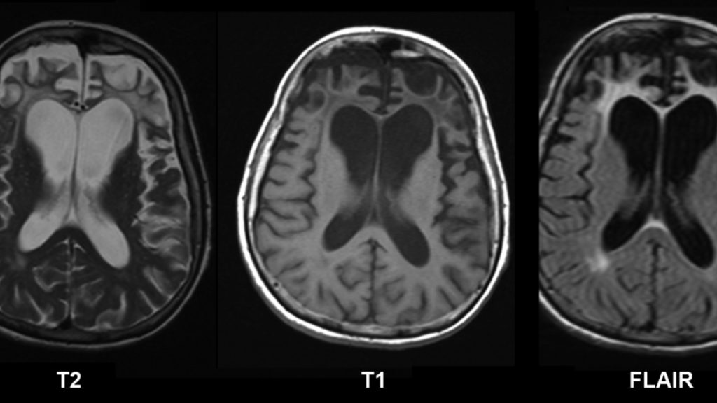 What Are The 7 Stages Of Frontotemporal Dementia ABTC   Frontotemporal Dementia 2 1024x576 