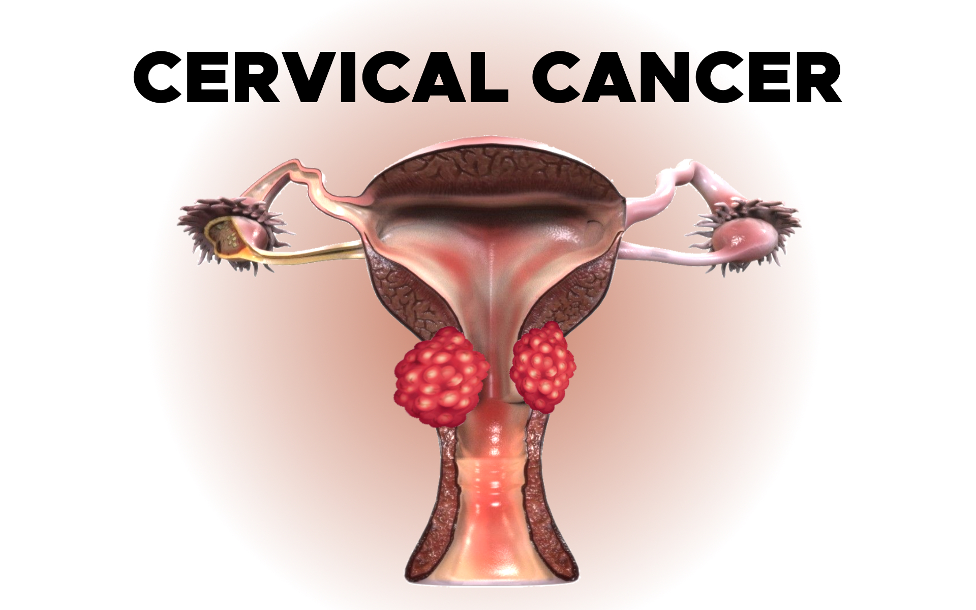 Can a 25 year old get cervical cancer? Can a 22 year old get cervical cancer?