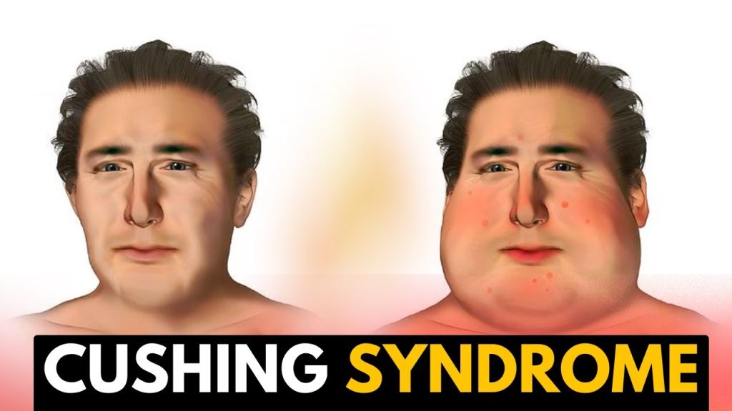 What are three or four symptoms of Cushing syndrome? What are three ...