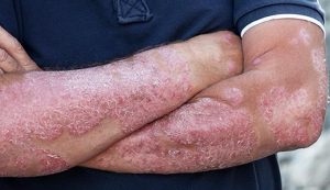 How does psoriasis look at first? What does psoriasis look like? - ABTC