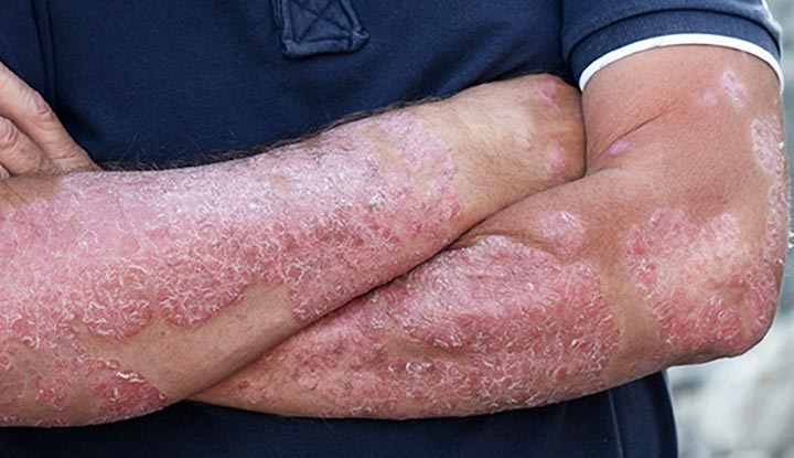 Symptoms Of Psoriasis ABTC   Psoriasis6866 Psoriasis 