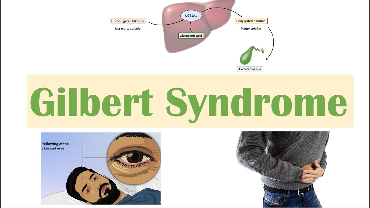 What does Gilbert's syndrome cause? - ABTC